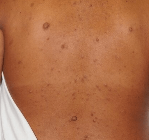 What Is NF1 Neurofibromatosis? A Complete Guide to Symptoms, Causes, and Management